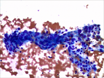 Cyst lining cells